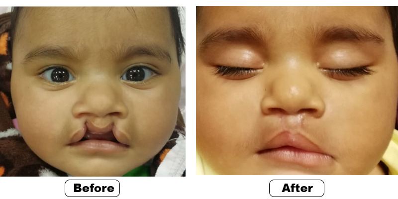 Cleft Lips